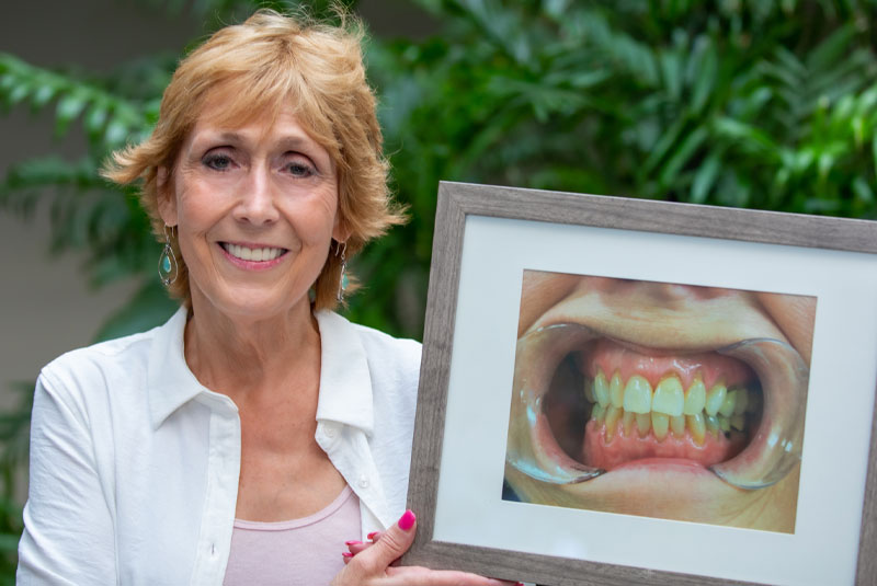 full arch dental implants patient